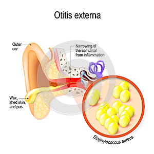 Swimmer`s ear. Otitis externa is inflammation of the ear canal and bacteria that cause this disease photo