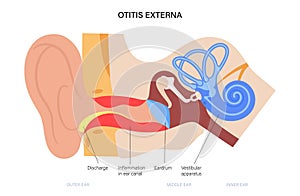 Swimmers ear otitis