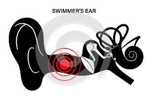 Swimmers ear otitis