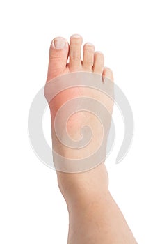 Swollen foot with gout inflammation photo