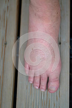 Swollen inflamed foot of a man from insect sting