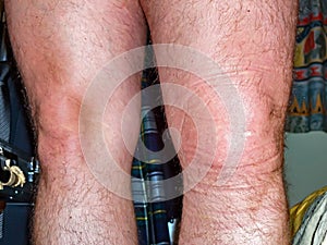 Swollen left knee akter ligament rupture ca 5 hours after the accident