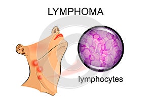 Swollen lymph nodes in lymphoma. Oncology