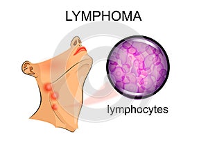 Swollen lymph nodes in lymphoma. Oncology photo