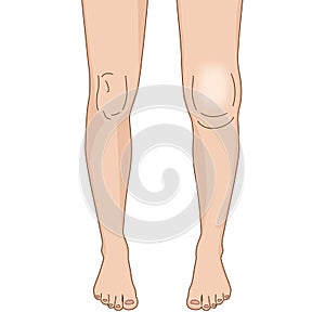 Swollen right knee, arthritis standing posture, illustration on white background