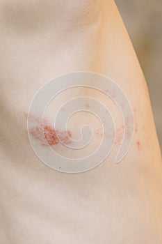 Symptom of herpes zoster shingles photo
