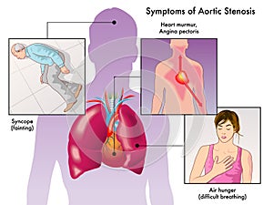 Symptoms of aortic stenosis