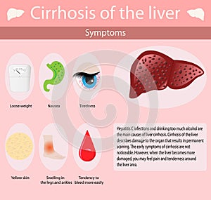 Symptoms of Cirrhosis oh the liver.