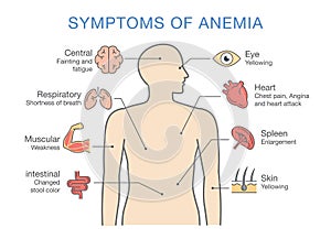 Symptoms common to many types of Anemia. photo