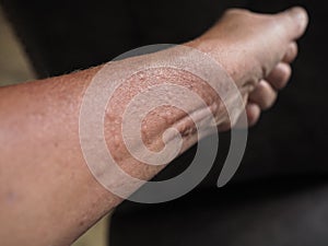 Symptoms of contact allergy on hand skin photo
