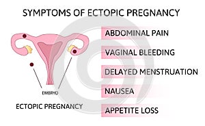 Symptoms of ectopic pregnancy. Infographics. illustration on isolated background. The fertilized egg, uterus, womb