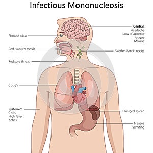 Symptoms and Effects of Infectious Mononucleosis