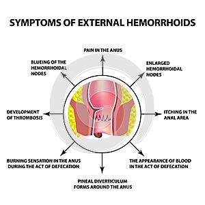 Příznaky z externí hemoroidy. uzel v,. infografiky. vektor ilustrace 