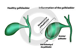 Symptoms of gallbladder inflammation. Cholecystitis.