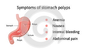 Symptoms of gastric polyps. pedunculated and flat-based polyp. Antrum. Anemia, nausea. Medical vector illustration marked with