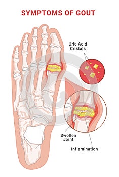 Symptoms of gout infographic scheme vector flat human foot with crystallization of uric acid