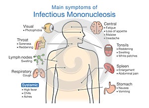 Symptoms of Infectious Mononucleosis disease.