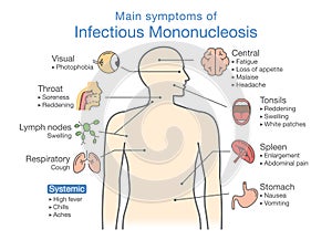 Symptoms of Infectious Mononucleosis disease. photo