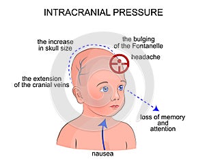 The symptoms of intracranial pressure in children photo