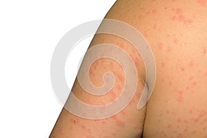 Symptoms of itchy urticaria. photo