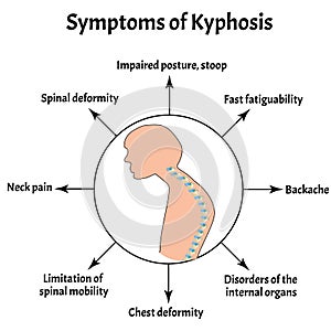 Symptoms of kyphosis. Spinal curvature, kyphosis, lordosis, scoliosis, arthrosis. Improper posture and stoop