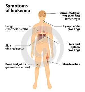 Síntomas de leucemia. sangre cáncer 