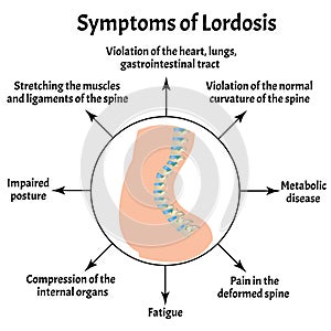 Symptoms of lordosis. Spinal curvature, kyphosis, lordosis, scoliosis, arthrosis. Improper posture and stoop