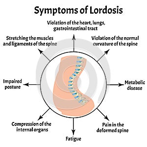 Symptoms of lordosis. Spinal curvature, kyphosis, lordosis, scoliosis, arthrosis. Improper posture and stoop photo