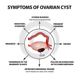 Symptoms of ovarian cyst. ovaries structure. Infographics. Vector illustration on isolated background. photo