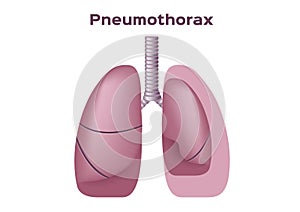 A symptoms of pneumothorax lung