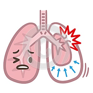 Symptoms of pneumothorax lung vector