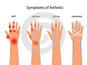 Symptoms of rheumatoid arthritis, redness, edema, numbness. Pain in the hands with autoimmune disease vector poster