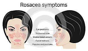 Symptoms of Rosacea