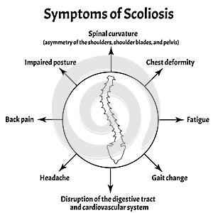 Symptoms of Scoliosis. Spinal curvature, kyphosis, lordosis of the neck, scoliosis, arthrosis. Improper posture and photo