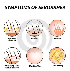 Symptoms of seborrhea. Seborrhea skin and hair. Dandruff, seborrheic dermatitis. Baldness, hair growth, baldness