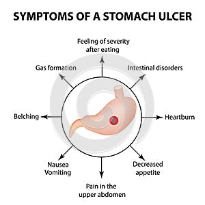 Symptoms of a stomach ulcer. Infographics. Vector illustration on background