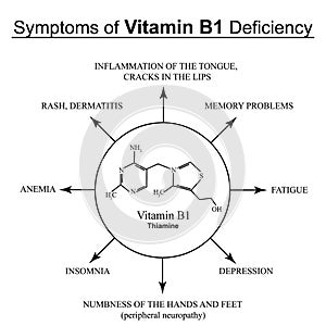 Symptoms of vitamin B1 deficiency. Infographics. Vector illustration on an isolated background.