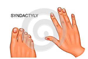 Syndactyly. webbed hand and foot