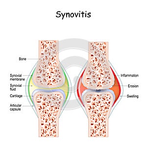 Synovitis. Close-up healthy joint and a joint with inflammation of the synovial membrane.