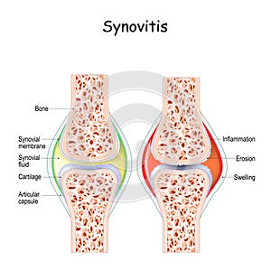 Synovitis. Close-up healthy joint and a joint with inflammation of the synovial membrane. photo