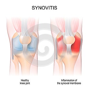 Synovitis. Human Knee joint anatomy photo