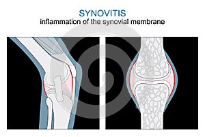 Synovitis. inflammation of the synovial membrane. Knee and Synovial joint photo