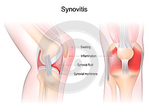 Synovitis of a Knee. Frontal and side view of human knee joint photo