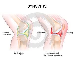 Synovitis of a Knee joint photo