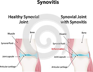 Synovitis