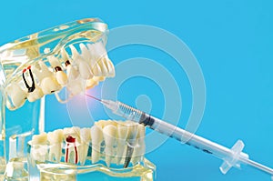 A syringe with an anesthetic anesthetic drug makes an injection into an inflamed tooth of a mock-up of a medical dental