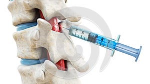 Syringe in the spinal cord isolated on a white background. Backbone or spinal column treatment with epidural injection 3D