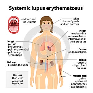 Systemic lupus erythematosu