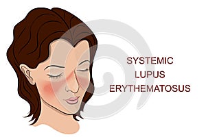 Systemic lupus erythematosus photo
