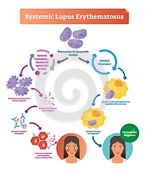 Systemic lupus erythematosus labeled diagram with normal and sick patient.